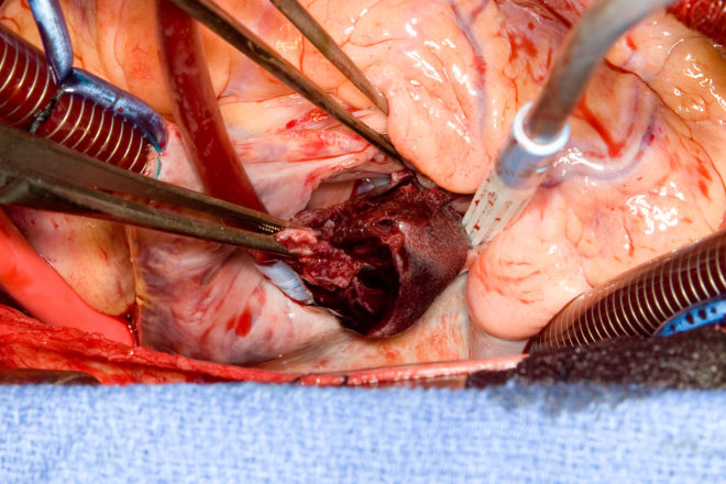 фото операции на удаление сгустка крови в сердце