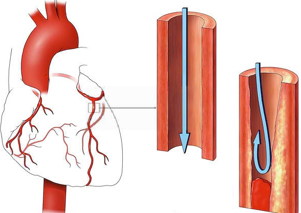 тромб в сердце сравнение с нормальной артерией