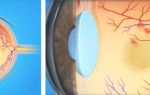 Как чем можно вылечить тромбоз глаз