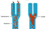 Тромбоз при пониженном давлении