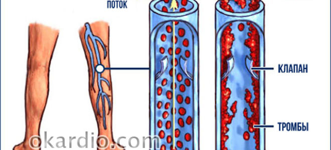 Как распознать тромбофлебит в ноге
