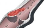 Гострий тромбоз артерій нижніх кінцівок