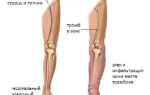 Венозный тромбоз нижних конечностей лечение