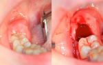 Артериальное давление после удаления зуба