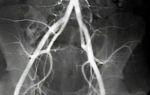 Тромбоз глубоких артерий нижних конечностей мкб 10