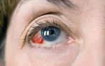 Является тромбоз глаза следствием инсульта