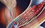 Тромбоз глубоких вен икроножных мышц