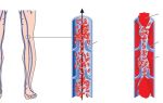Артериальный тромбоз причины и симптомы