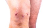 Тромбоз после артроскопии коленного сустава