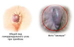 Тромбоз геморроидального узла хирургическое