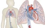 Острый тромбоз внутренней сонной артерии