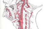 Тромбоз левой позвоночной артерии что это такое