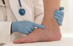 Чем лечить острый тромбофлебит на ногах