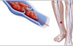 Венозный тромбоз ног и лечение его