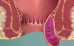 Что такое перианальный венозный тромбоз