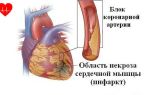 Артериальное давление при угрозе инфаркта