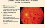 Тромбоз центрального зрительного нерва