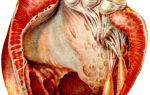 Тромбоз полости левого желудочка
