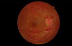 Что такое тромбоз глаза и как лечить