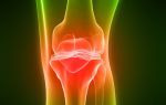 Как лечить тромбофлебит выше колена