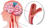 Артериальный тромбоз головного мозга