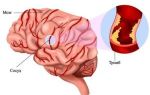 Тромбоз артерии в головном мозге