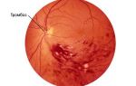 Как лечить тромбоз сетчатки глаз
