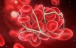 Что такое тромбоз вен и артерий