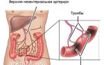 Тромбоз верхней брыжеечной артерии причины