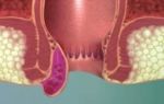 Облепиховое масло тромбоз геморроидальных узлов