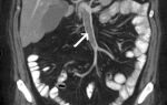 Тромбоз нижней брыжеечной артерии