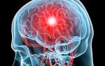 Синус тромбоз головного мозга лечение