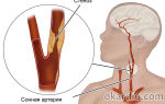 Стеноз и тромбоз внутренней сонной артерии