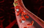 Геморроидальный тромбоз может пройти сам